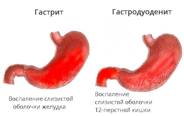 Гастрит, становящийся хроническим, и его совместимость с военной службой