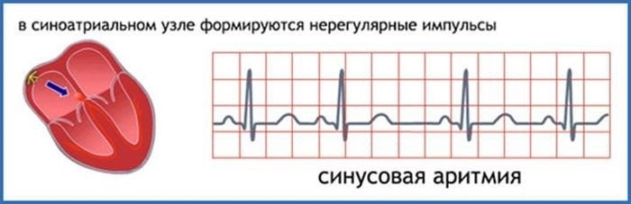 Синусовая аритмия - это физиологическое состояние, при котором изменяется сердечный ритм и частота сокращений сердца в соответствии с дыхательным циклом. Это явление связано с влиянием дыхания на автономную нервную систему и синусным узлом, который является естественным пэсмэйкером сердца. В результате такой аритмии, интервалы между сердечными сокращениями становятся неравномерными, что может быть обнаружено при кардиологическом обследовании. Несмотря на название 